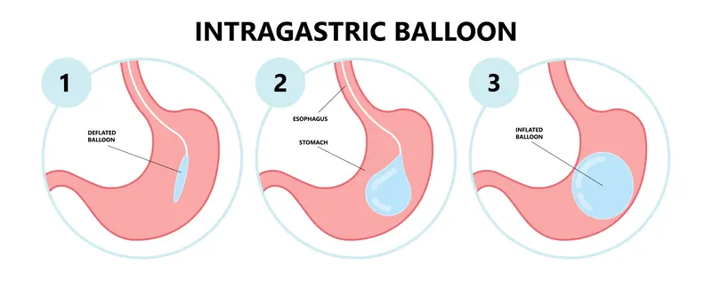 Gastric-Balloon